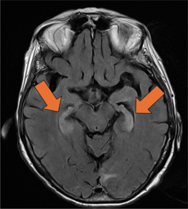 Misleading Detection of Herpes Simplex Virus Type 1 In A Patient with Paraneoplastic Encephalitis.