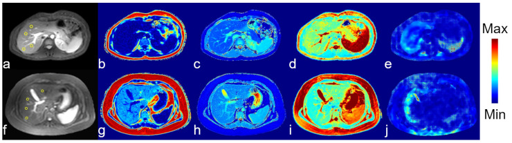Feasibility of Sodium and Amide Proton Transfer-Weighted Magnetic Resonance Imaging Methods in Mild Steatotic Liver Disease.
