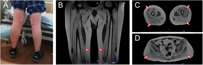 Decreased β-cell function in a case with Becker muscular dystrophy accompanied by post-transplant diabetes.