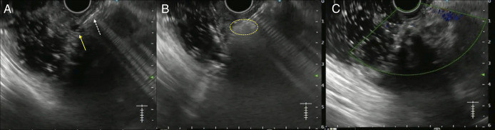Expanding Horizons of Vascular Interventions: Endoscopic Ultrasound-Guided Angioembolization for a Refractory Upper Gastrointestinal Bleed From a Gastric Dieulafoy Lesion.