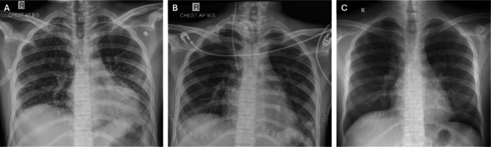 Lung Transplantation Following Paraquat Poisoning: Time to Think.