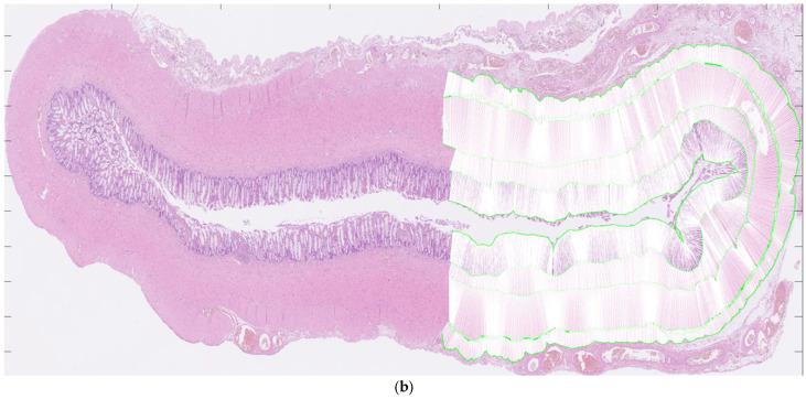 Histoanatomic Features Distinguishing Aganglionosis in Hirschsprung's Disease: Toward a Diagnostic Algorithm.