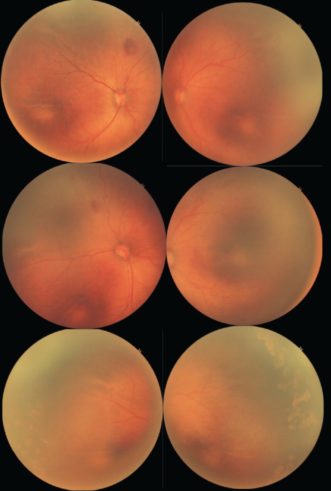 Effect of Ranibizumab in Patients with Treatment-Naïve Retinopathy of Prematurity.