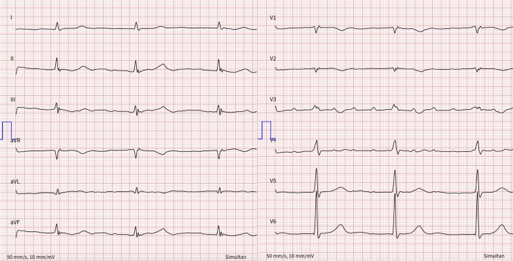 Role of atrial fibrillation ablation in the management of atrial mitral and atrial tricuspid regurgitation: a case report.