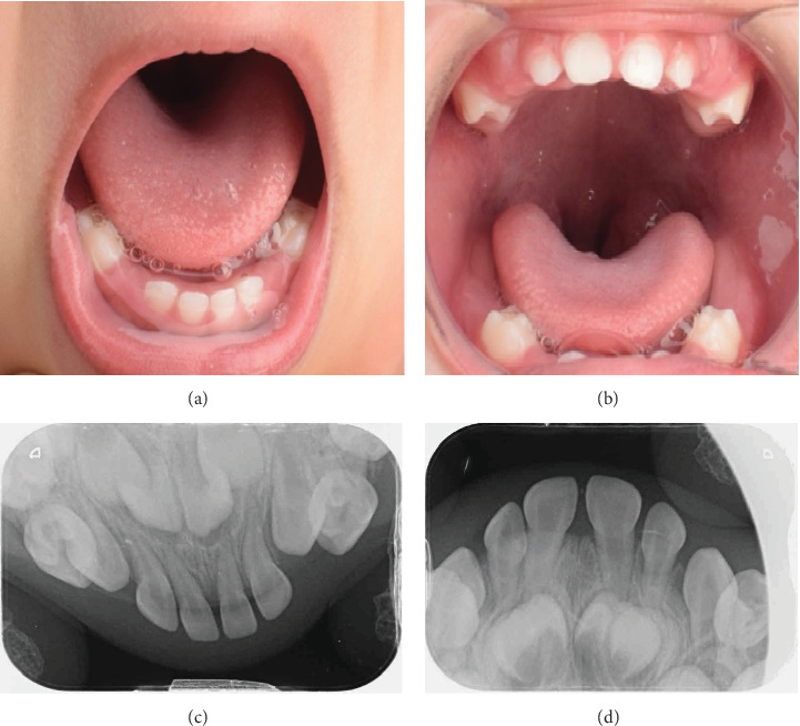 The Intersection of Genitopatellar Syndrome and Oral Health: A Case Report at Saudi Arabia.