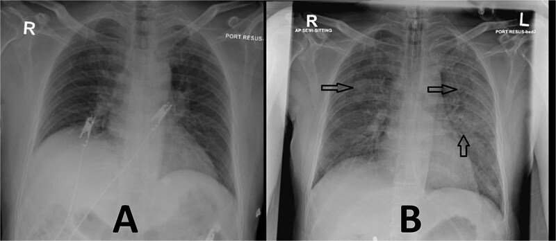 Severe cardiopulmonary complications of ketamine: Acute pulmonary Edema in a cardiac patient.