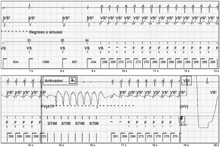Epicardial ablation of ventricular tachycardia in a patient with dilated cardiomyopathy due to Becker muscular dystrophy: a case report.