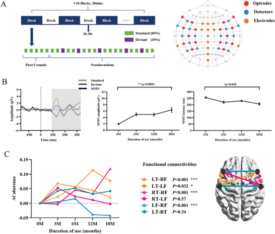 Neural Plasticity and Hearing-Speech Development in Children with Auditory Brainstem Implants for Congenital Hearing Loss Due to Severe Inner Ear Malformation.