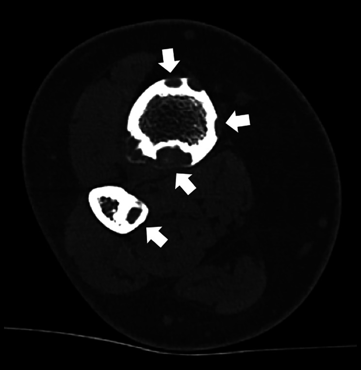 Osteofibrous Dysplasia Involving Both Tibia and Fibula: A Rare Campanacci‑Type Presentation.