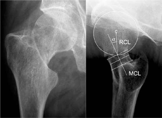 An Acta Orthopaedica educational article: Femoral neck fractures in adults with emphasis on surgical treatment.