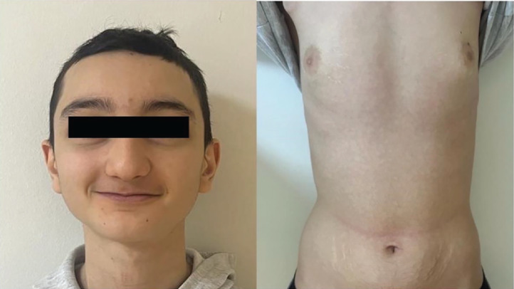 A Challenging Case of Ectopic Adrenocorticotropin Hormone Syndrome with Bronchial Carcinoid and Literature Review