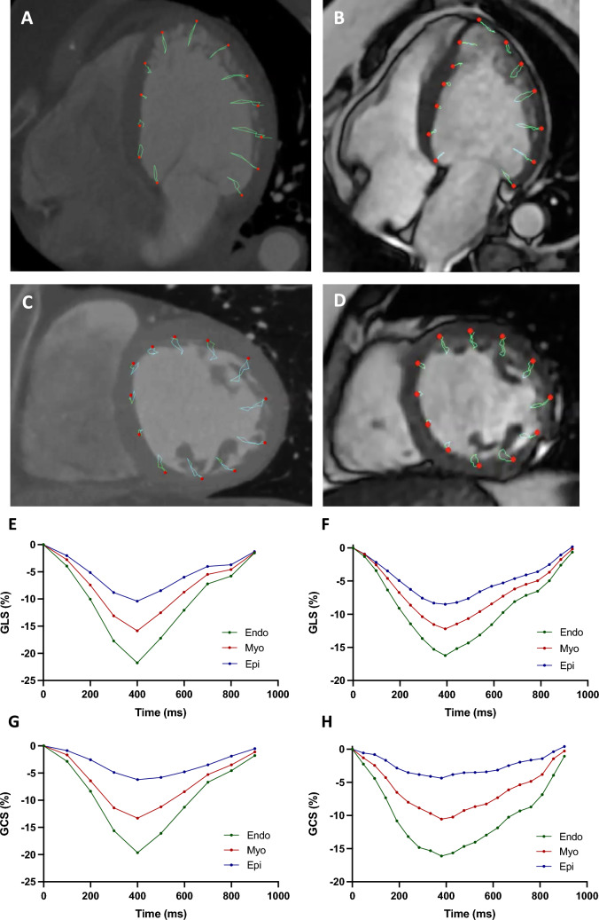 A comparative analysis of myocardial strain and strain rate in cardiac computed tomography and magnetic resonance feature tracking.