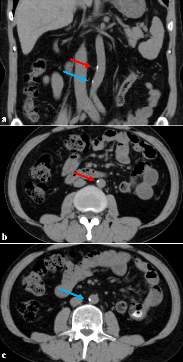 Extended-Hours Hemodialysis Without Dietary Restrictions Reduces Risk of Vascular Calcification.