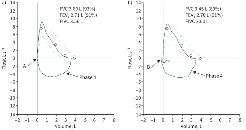 Spirometry update 2019: phase 4 forced maximal inspiration and new acceptability criteria.