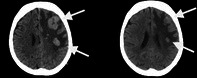 Lorlatinib Achieved Rapid CNS Response in an 81-Year-Old NSCLC Patient With Performance Status Deterioration.
