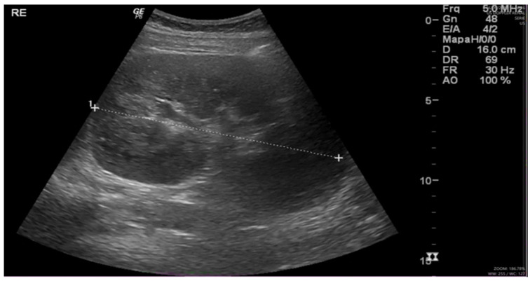 Renal Malacoplakia Following Obstetric Intervention: A Rare Cause of Acute Kidney Injury in a Young Woman.