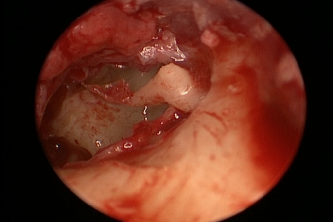 Thermal injury in endoscopic ear surgery between reality and fiction.