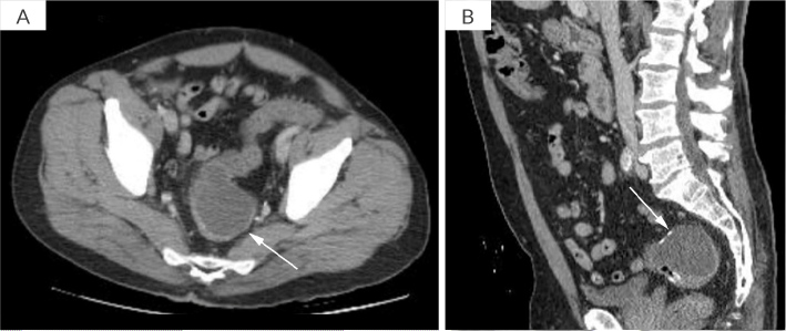 Endoscopic Ultrasound-Guided Drainage of Extraluminal Colorectal Mucocele Using A Lumen-Apposing Metal Stent: A Novel Approach.