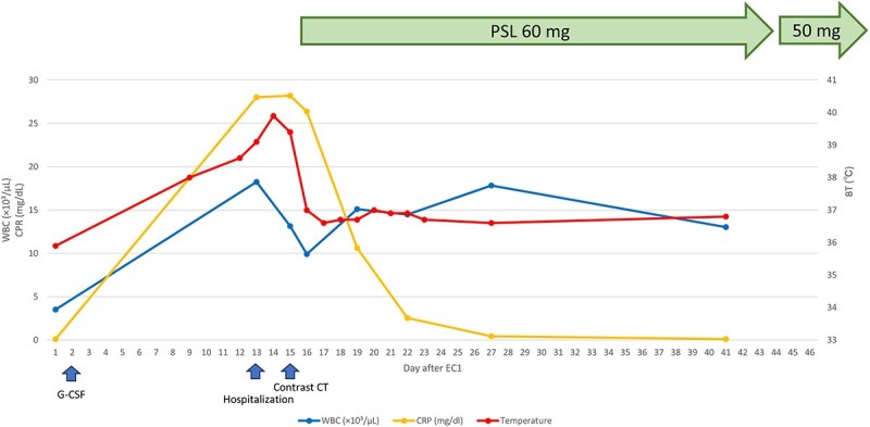 G-CSF-induced Aortitis in an elderly woman successfully managed with prednisolone: a case report and literature review.