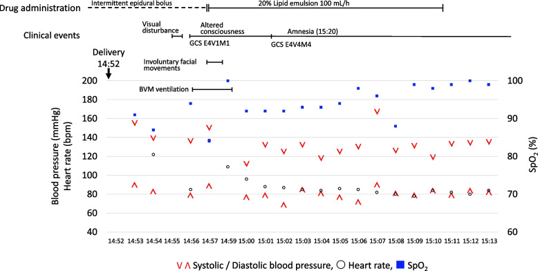 Posterior reversible encephalopathy syndrome during epidural labor analgesia: a case report.