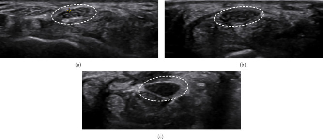 Evaluating Various Ultrasound Criteria for Determining Carpal Tunnel Syndrome Severity.