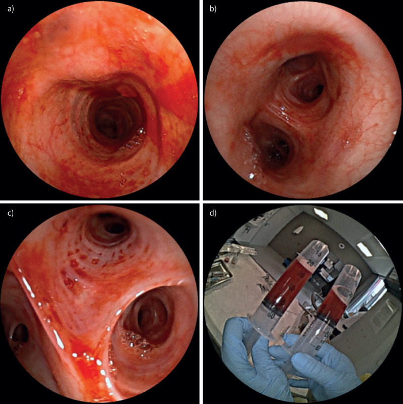 Acute post-operative respiratory insufficiency and diffuse alveolar haemorrhage in a young and healthy adult.