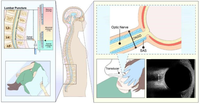 A prospective study of transorbital ultrasound multimodal imaging in the detection and evaluation of increased intracranial pressure.