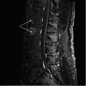 <i>Aerococcus urinae</i> Spondylodiscitis: A Case Report and Review of the Literature.