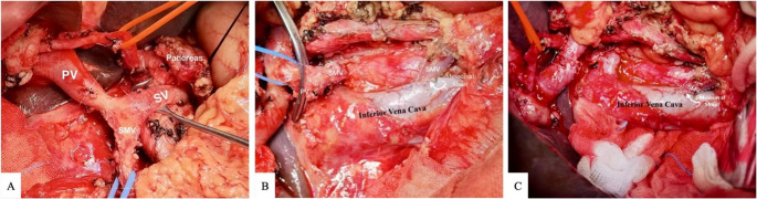 How-I-do-it: meso-caval shunt: a safe emergency option for venous reconstruction in pancreaticoduodenectomy.