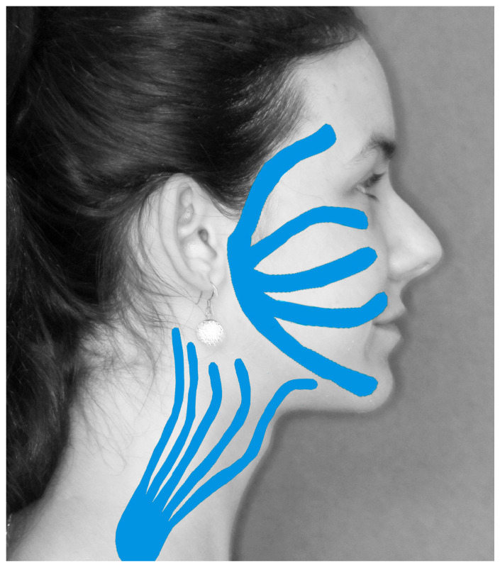 Risk of Permanent Dysfunction of Facial Nerves After Open Rigid Internal Fixation in the Treatment of Mandibular Condylar Process Fracture.