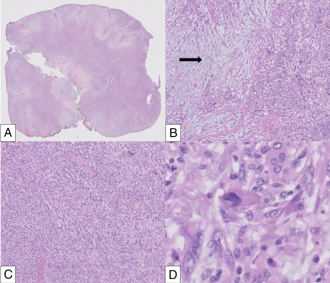 Pseudo-Pseudo Polyp: Spindle Cell Sarcoma at an Ileocolonic Anastomosis.