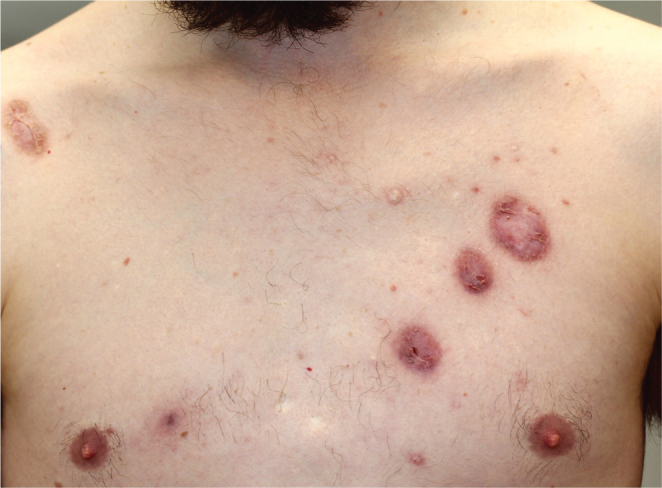 PAPASH Syndrome with a Pathogenic PSTPIP1 p.(Ala230Thr) Variant: A Case Report of Therapeutic Complexity.