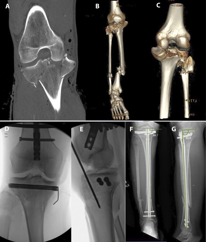 Residual radiographic fracture displacement in healed tibial plateau fractures: comparison after treatment with suprapatellar nailing versus lateral plating.
