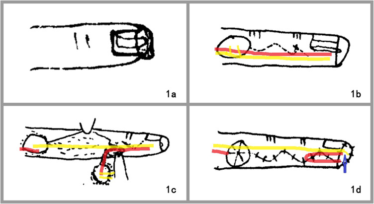 Similar Diameter of Cutaneous Branches of the Proper Digital Nerve and Stump of the Proper Palmar Digital Nerve was a Key Factor for the Sensory Reconstruction in Short Term Outcome of Finger Pulp Defects: A Retrospective Study.