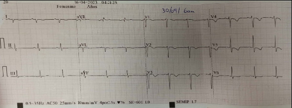 Brugada Phenocopy Associated With Toxic Myocarditis due to Aluminum Phosphide: A Case Report.