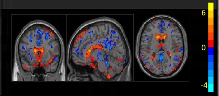 Altered effective connectivity in leucine-rich glioma-inactivated 1 antibody encephalitis: a spectral dynamic causal modeling study.