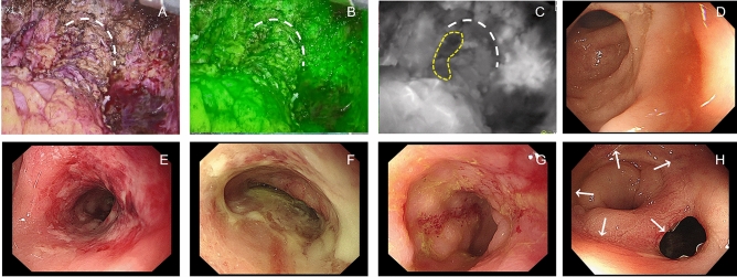 Clinical value of fluorescence laparoscopic surgery on anastomotic leakage prevention in ultra-low rectal cancer: real-world multicenter retrospective evidence with neoadjuvant chemoradiotherapy stratification.