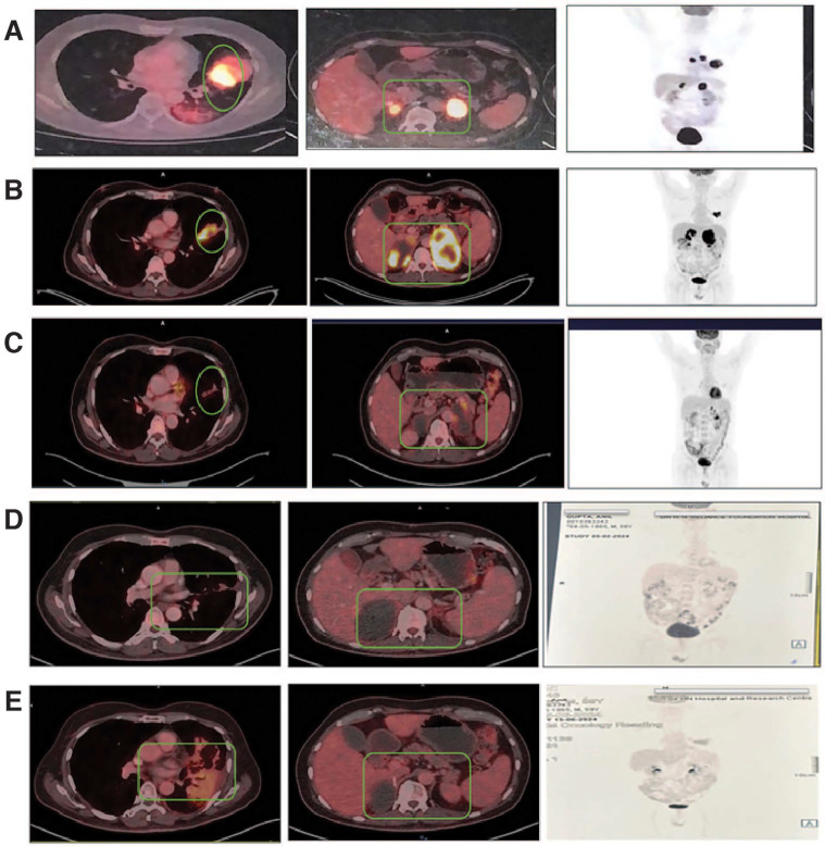 Exceptional Response to Immunotherapy-based Treatment in Compound <i>EGFR</i>-Mutated Oligometastatic Pulmonary Sarcomatoid Carcinoma: A Case Report.