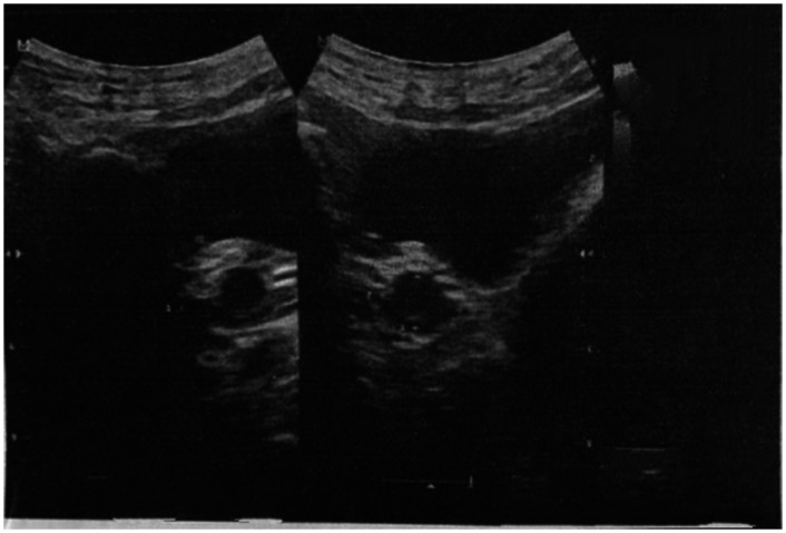 Swyer syndrome in a Syrian female: A rare case report.