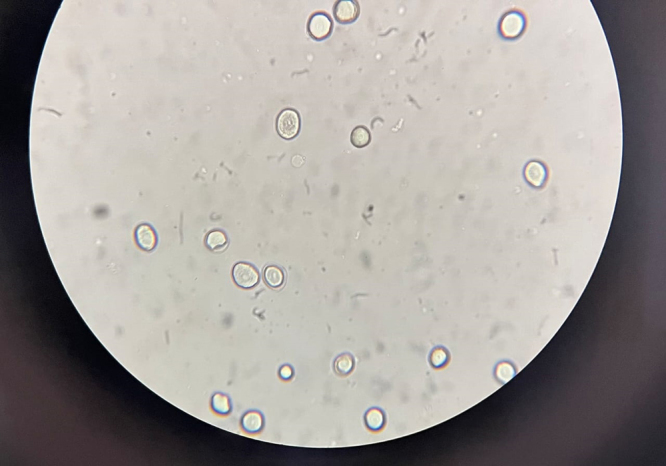 First report of adult Taenia solium in human brain with neurocysticercosis: illustrative case.