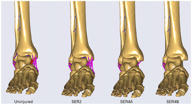 A Pilot Validation Study of a Biomechanical Simulation Model for Rotational Ankle Injuries Using Robotic Cadaveric Testing.
