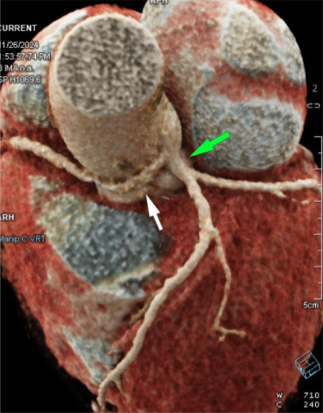 Anomalous Origin of the Right Coronary Artery from the Left Main Coronary Artery in A Patient with Non-Specific Chest Pain.