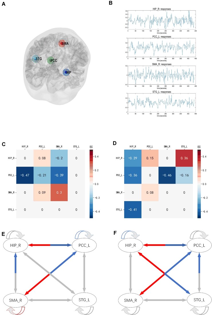 Altered effective connectivity in leucine-rich glioma-inactivated 1 antibody encephalitis: a spectral dynamic causal modeling study.