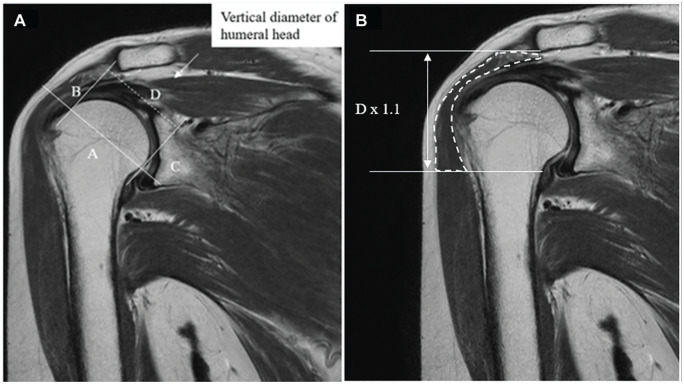 Deltoid Muscle Volume After Superior Capsule Reconstruction in Patients With Irreparable Rotator Cuff Tears: A 3-Dimensional Magnetic Resonance Imaging Analysis.