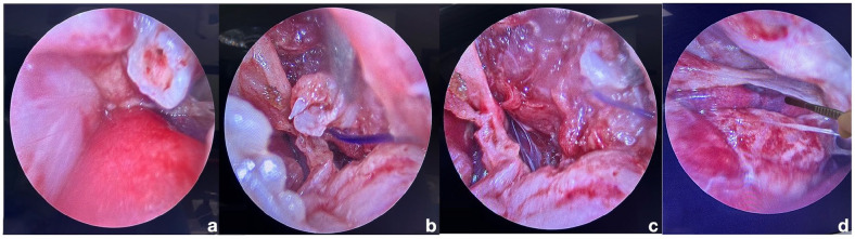 Video-assisted thoracoscopic-guided reduction and external stabilisation of traumatic rib fractures in a cat.