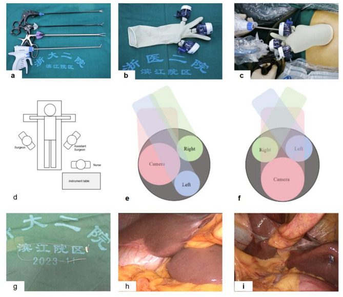 Single-incision laparoscopic cholecystectomy with inflexible laparoscopic instruments and laparoscopy: a single-center experience of 533 cases.