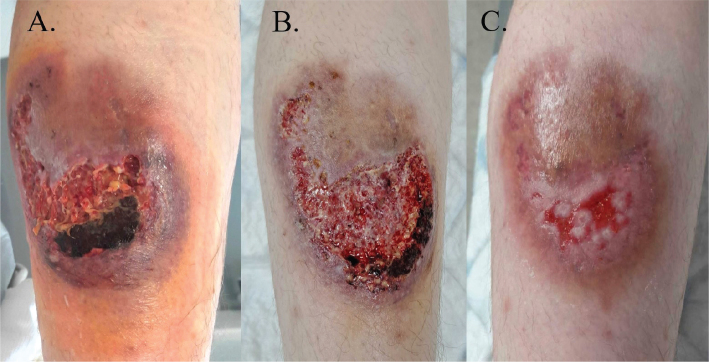 PAPASH Syndrome with a Pathogenic PSTPIP1 p.(Ala230Thr) Variant: A Case Report of Therapeutic Complexity.