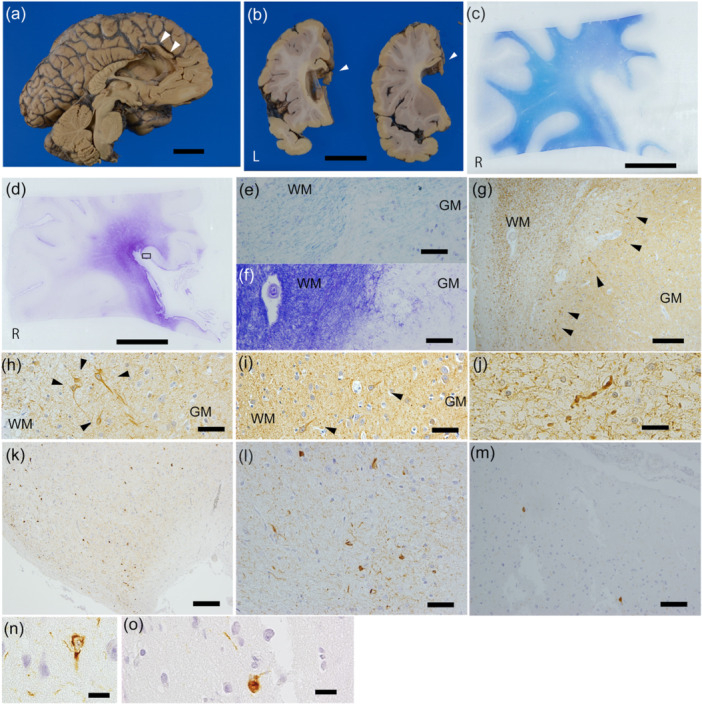 Histopathological findings in the brain decades after cingulotomy: An autopsy case.