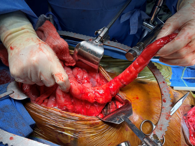 Esophageal reconstruction using a hypopharyngeal anastomosis - a single center experience with review of the literature.