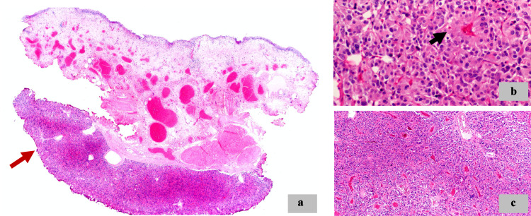 An Unusual Entity in Urology: Urinary Bladder Paraganglioma.